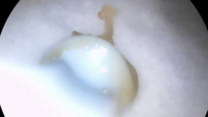 Ear Wax Cleaning