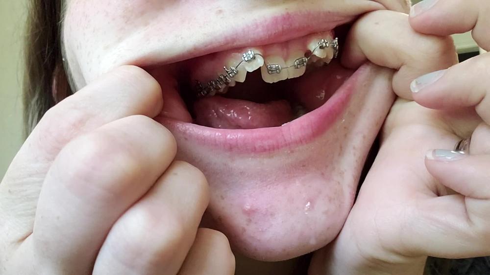 Mouth Spit And Braces Worship