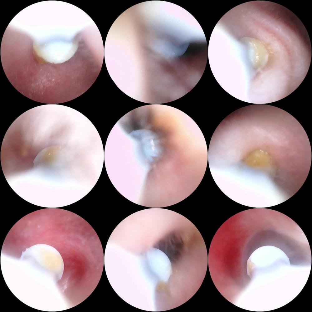 Ear Wax Cleaning