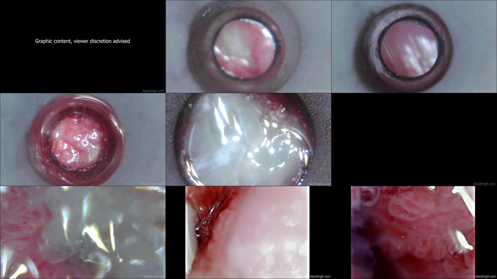 Cervical Canal 4K - Mar 15, 2022